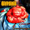 Lipoma - Pathology for Life