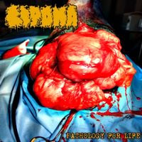 Lipoma - Pathology for Life