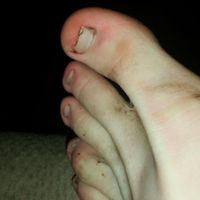 PcPowerUp - Ingrown Toenail
