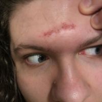 Cheers, Pricks!! - Third Eye Opening Scar